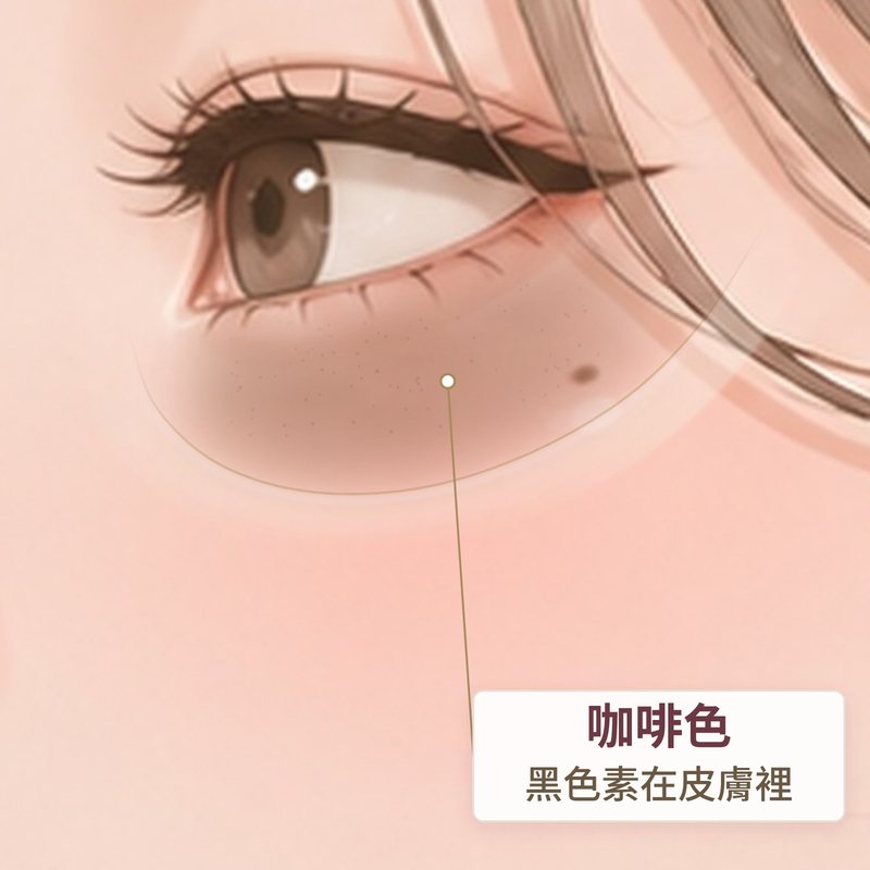 色素型黑眼圈示意：下眼皮皮膚一片淡咖啡色，邊界清楚｜妍回美學診所