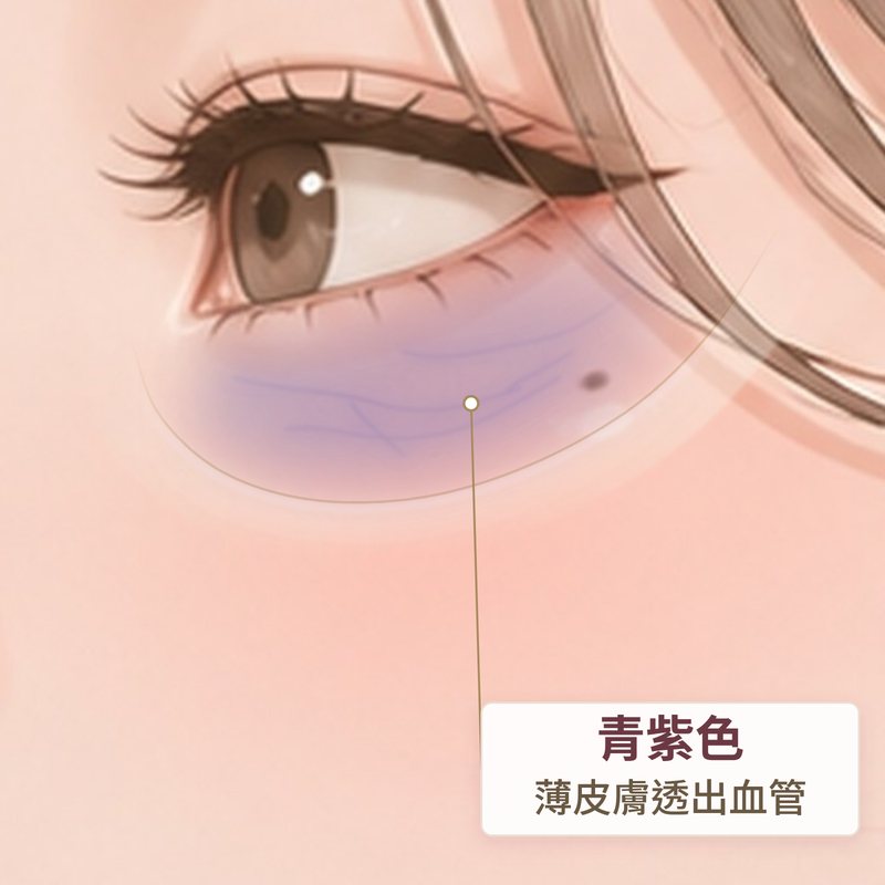 血管型黑眼圈示意：下眼皮薄，皮下血管透出青紫色｜妍回美學診所