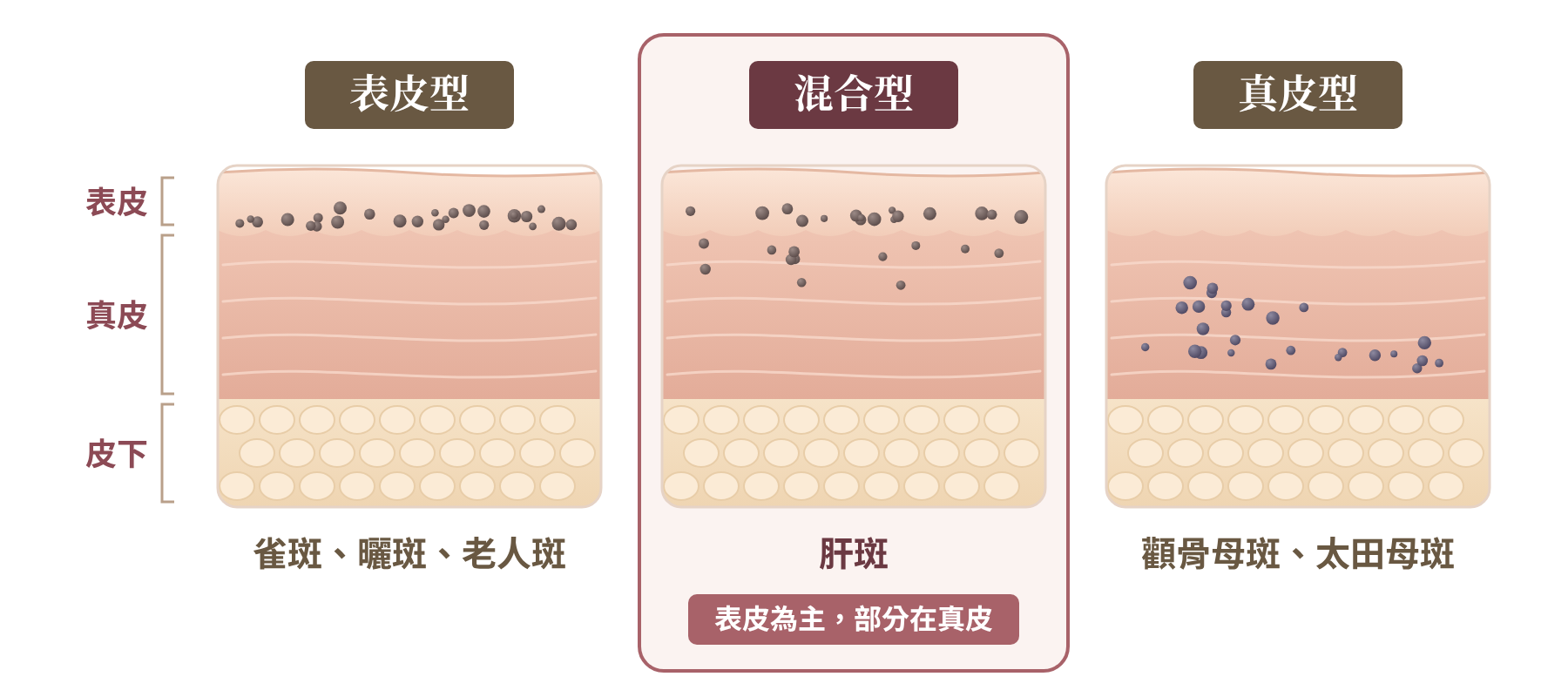 肝斑形成原因與色素位置｜皮膚解剖圖：表皮型：雀斑、曬斑、老人斑；混合型：肝斑，色素以表皮為主、部分在真皮；真皮型：顴骨母斑、太田母斑｜妍回美學診所