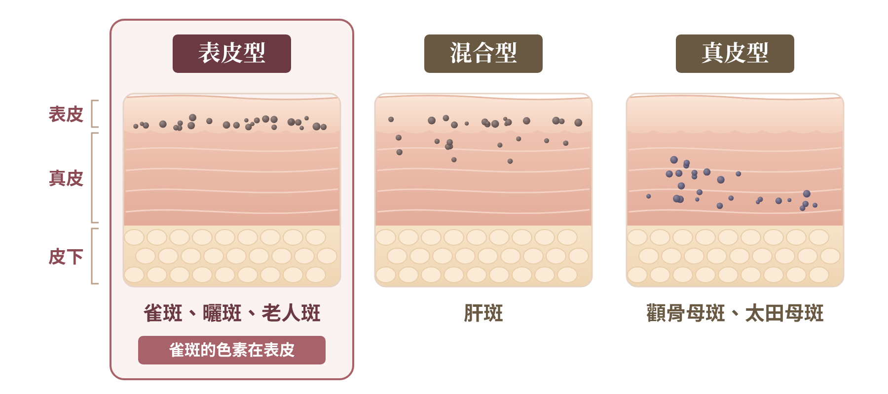 皮膚解剖圖｜表皮型：雀斑、曬斑、老人斑；混合型：肝斑；真皮型：顴骨母斑、太田母斑，雀斑的色素在表皮｜妍回美學診所