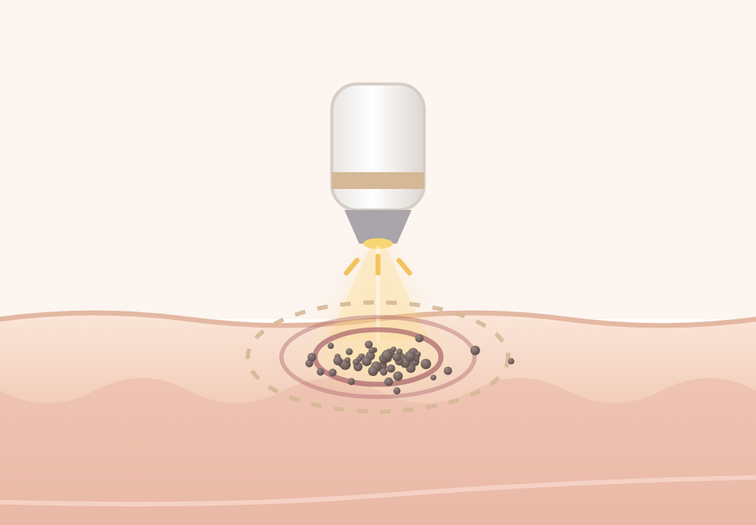 雀斑怎麼消除第 2 步|光震波把表皮的色素震成細粉|妍回美學診所