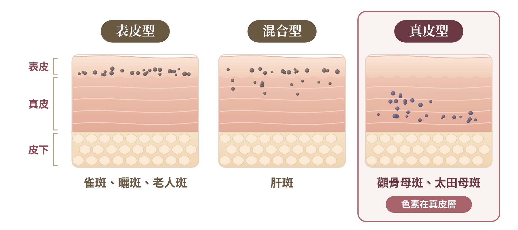 皮膚解剖圖｜表皮型：雀斑、曬斑、老人斑；混合型：肝斑；真皮型：顴骨母斑、太田母斑，顴骨母斑的色素在真皮｜妍回美學診所