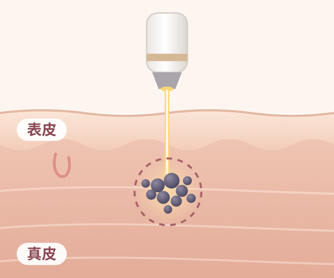 顴骨母斑怎麼去除第 1 步｜縮小光點對準真皮的斑點，能量集中在顴骨的色素上｜妍回美學診所