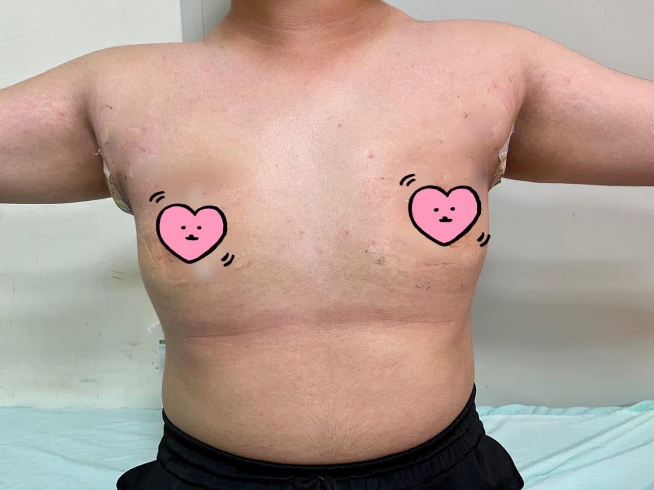 女乳症術後