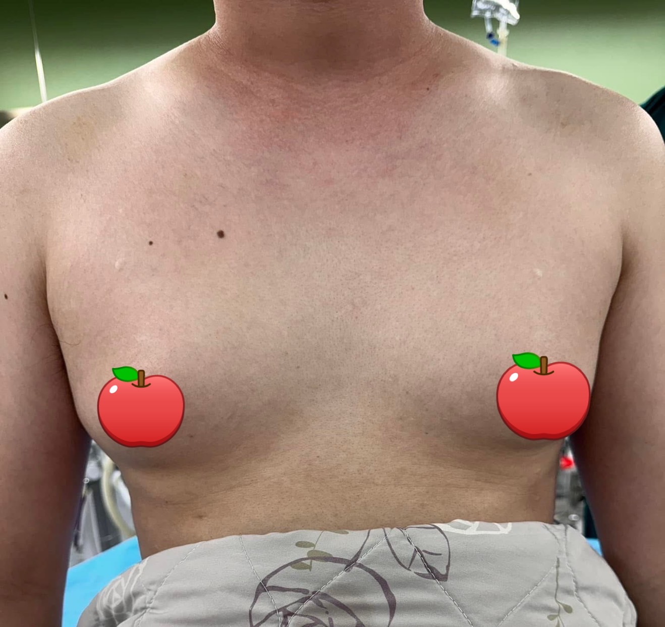 女乳症術前