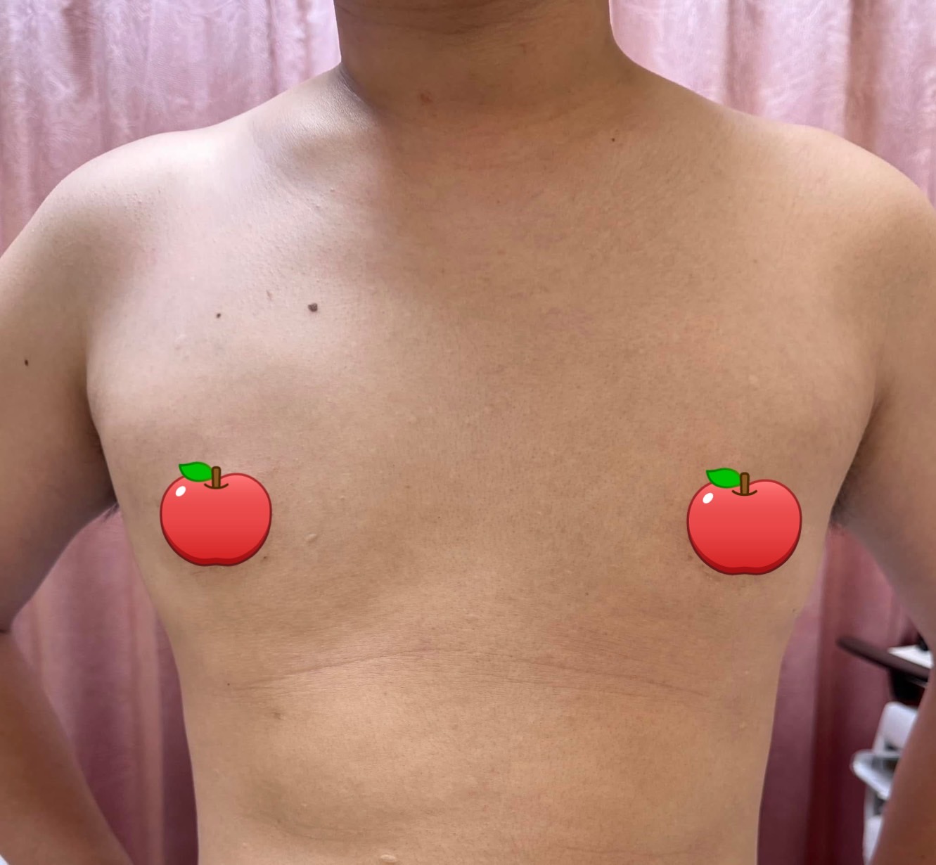 女乳症術後