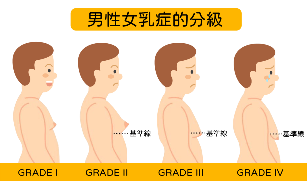 女乳症分級