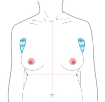 乳暈切口