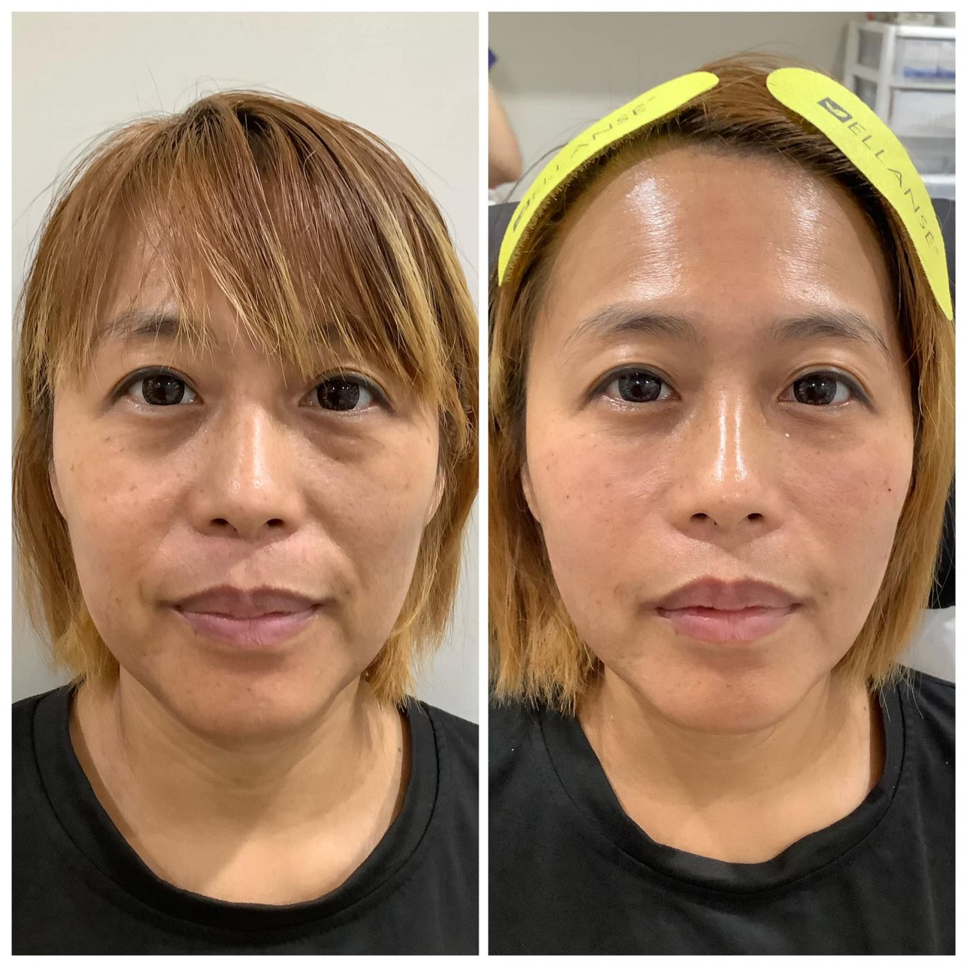 法令紋治療BA對比圖