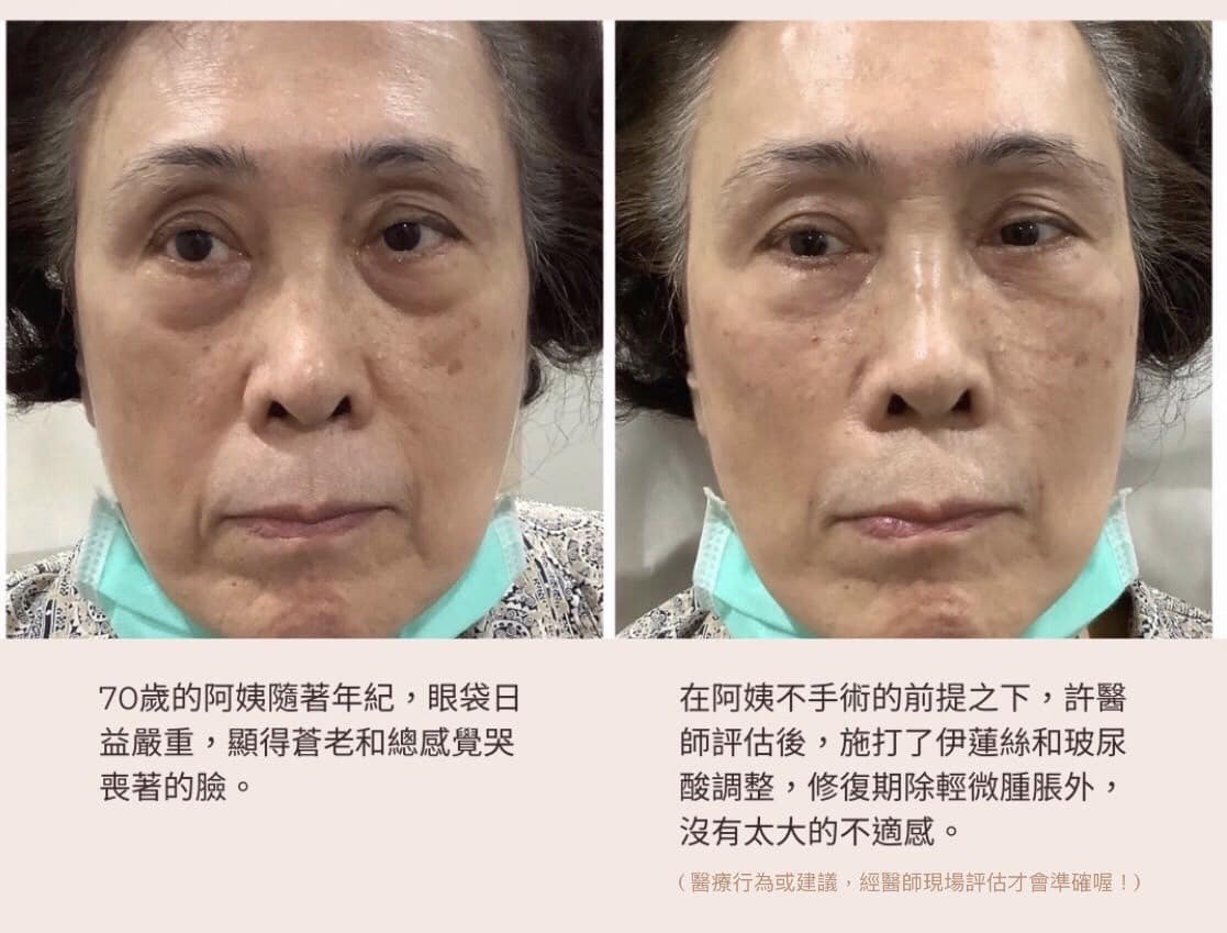 70歲阿姨術後改善案例