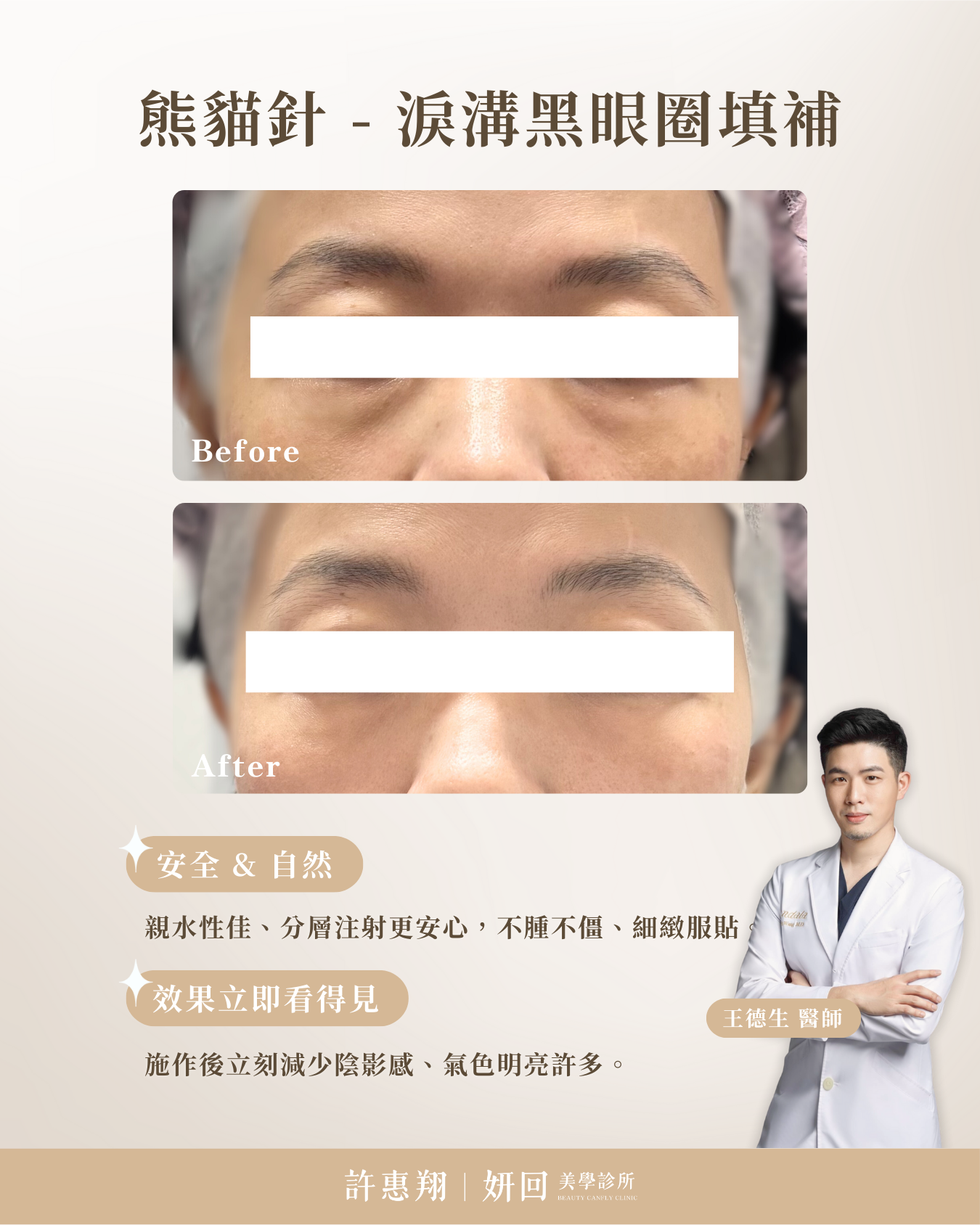 淚溝黑眼圈填補真實案例