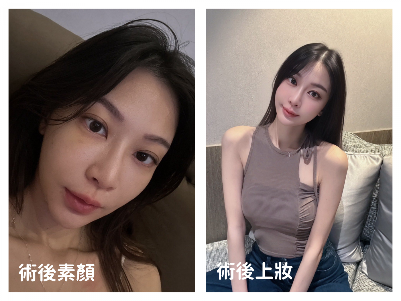 術後蘋果肌飽滿效果