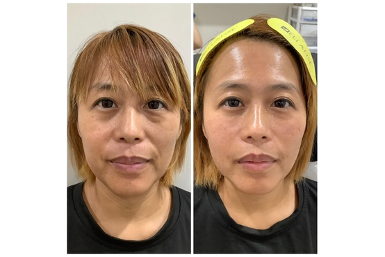 法令紋分型治療與結構式評估