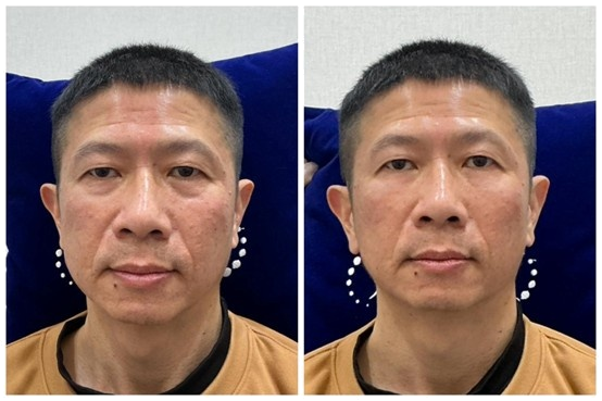 膚漾美 G4 熊貓針 第四代膠原蛋白