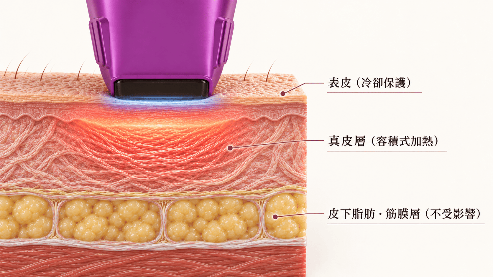 鳳凰電波 Thermage FLX 射頻能量作用真皮層示意圖