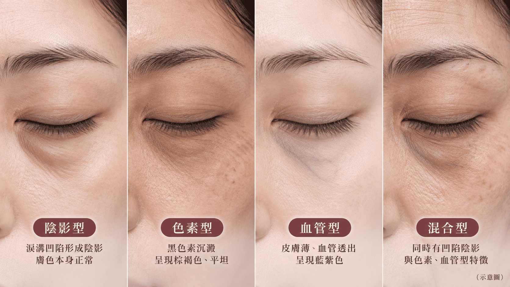 黑眼圈三大分型示意：結構型、色素型、血管型