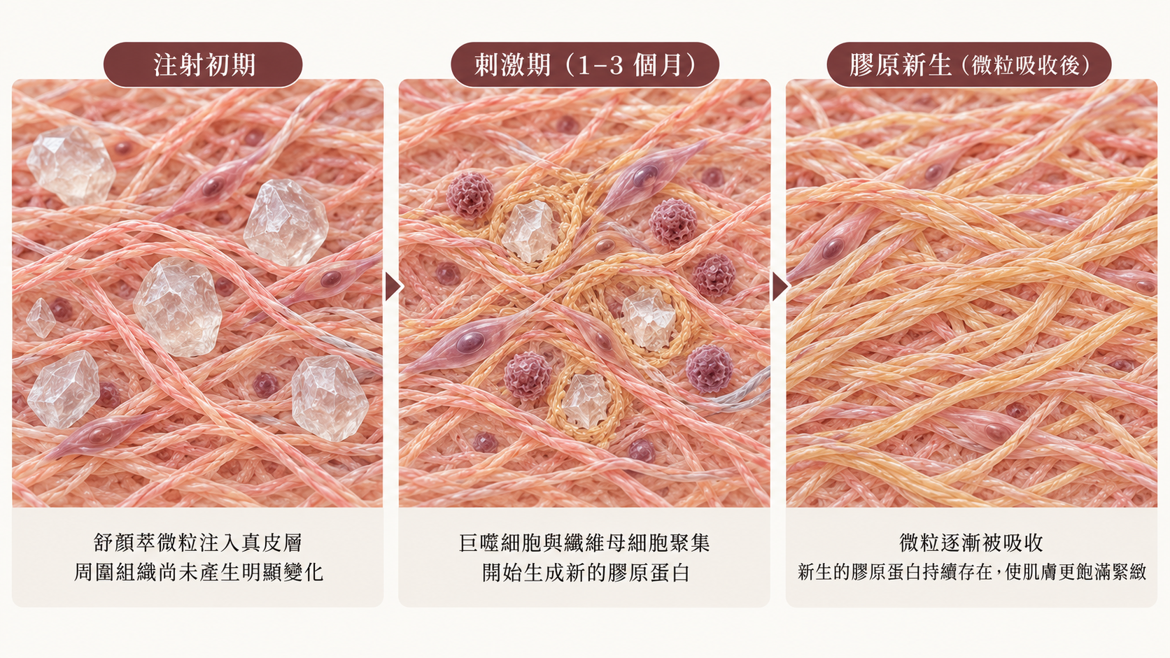 舒顏萃PLLA刺激膠原蛋白增生機制示意圖