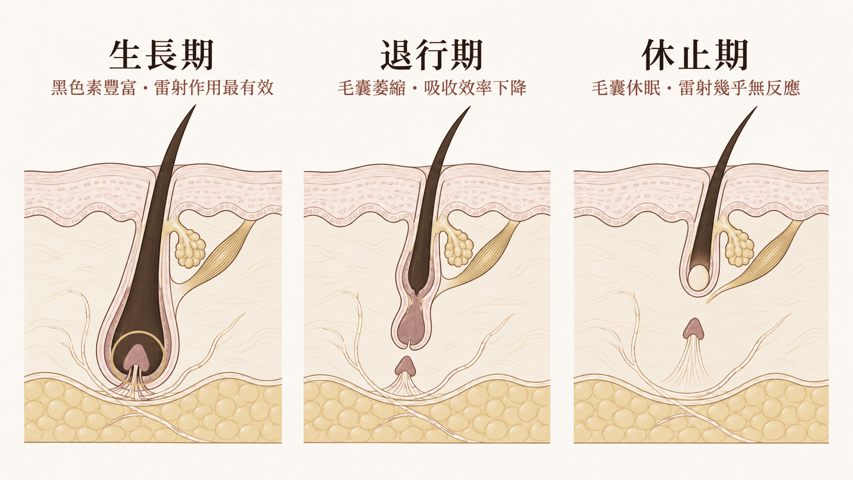 妍回美學診所雷射除毛療程示意