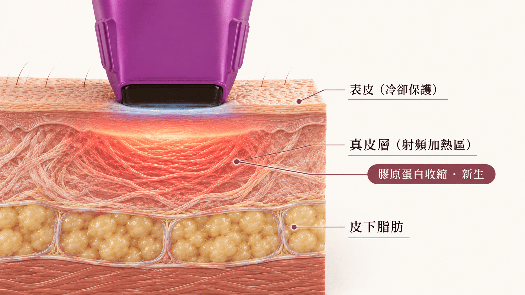 鳳凰電波 Thermage FLX 射頻作用真皮層示意圖