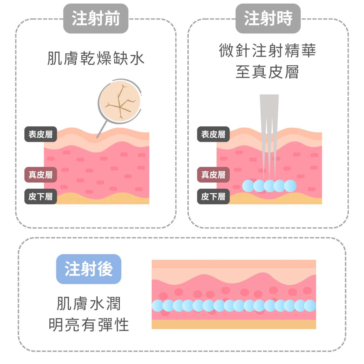 水光針深層補水原理