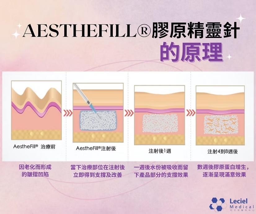 精靈針 AestheFill 膠原新生原理圖：治療前凹陷、注射後立即支撐、一週後水分吸收、4 至 8 週膠原蛋白增生
