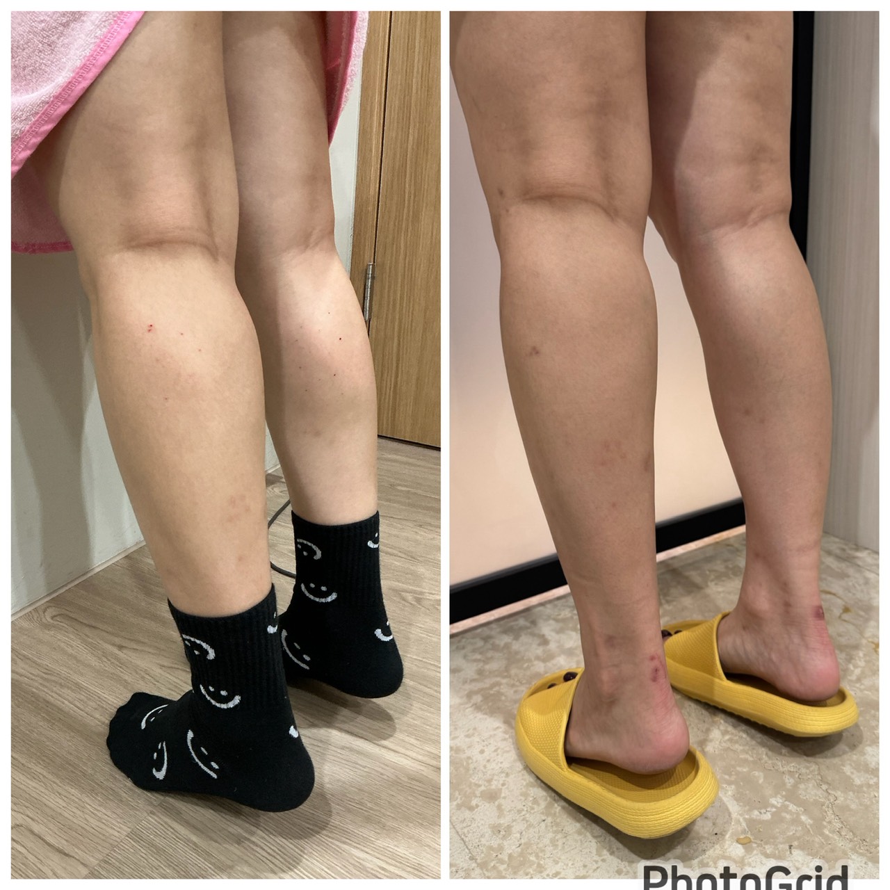 小腿肉毒真實案例：施打前後的小腿三個角度對照