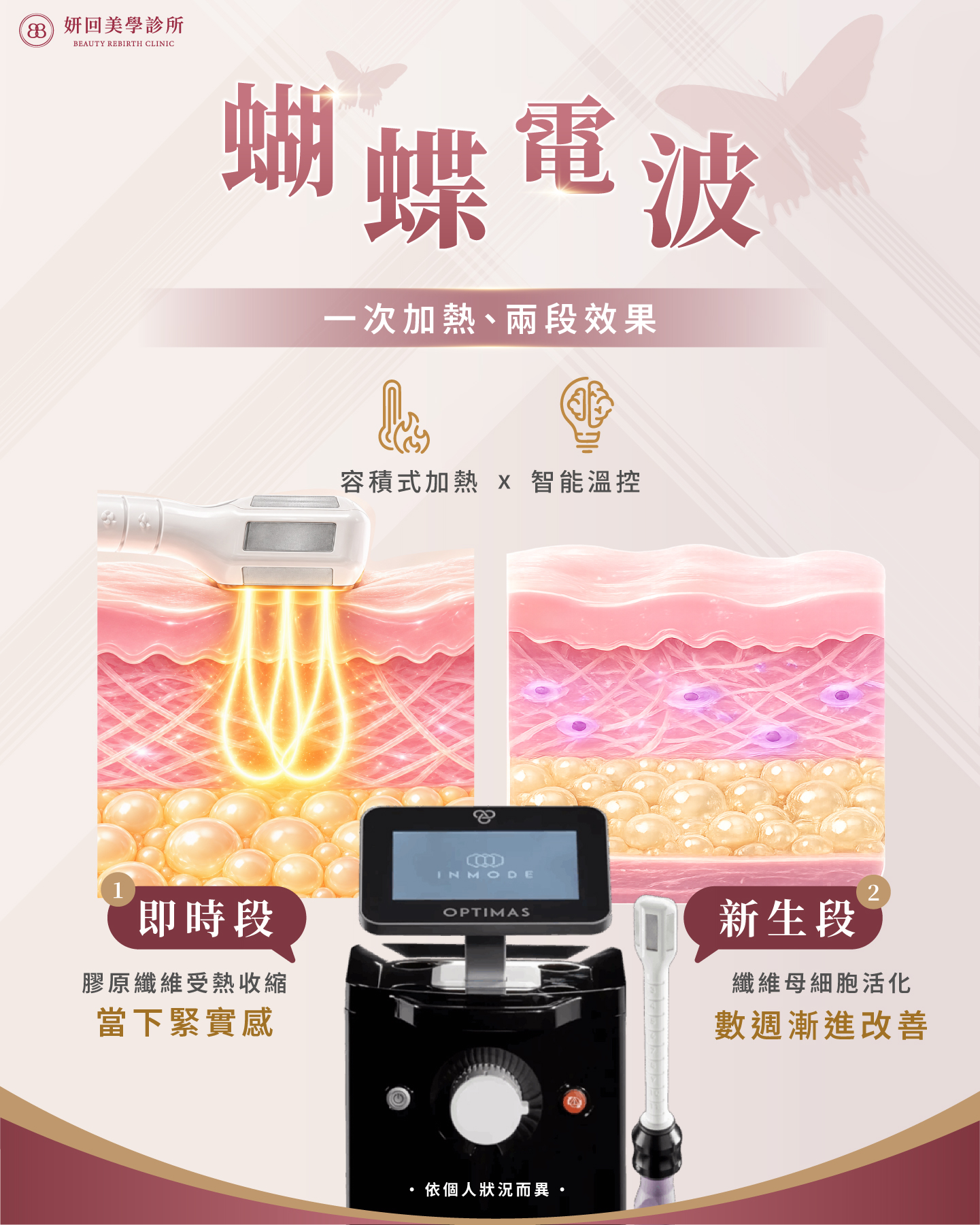 蝴蝶電波一次加熱、兩段效果：膠原纖維受熱收縮與纖維母細胞活化