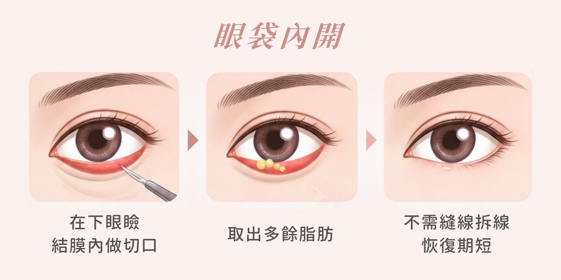 眼袋內開三步驟：下眼瞼結膜內切口、取出多餘脂肪、免拆線｜妍回美學診所