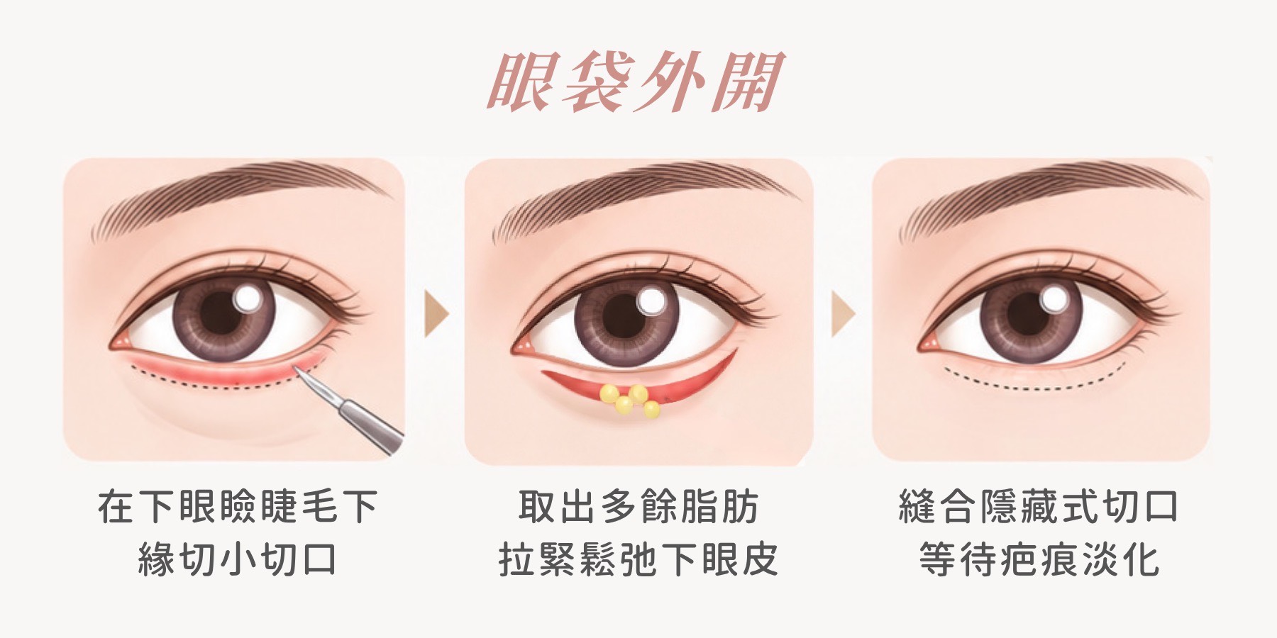 眼袋外開三步驟：睫毛下緣切口、取出脂肪並拉緊下眼皮、縫合隱藏式切口｜妍回美學診所