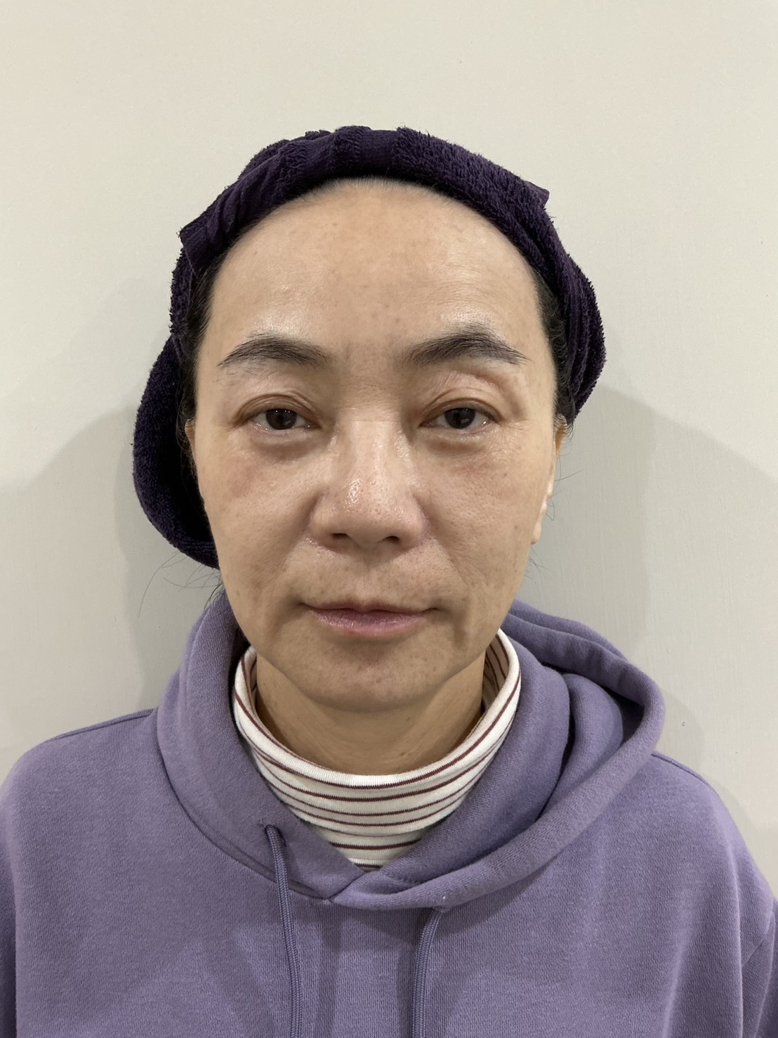 鳳凰電波治療前正面