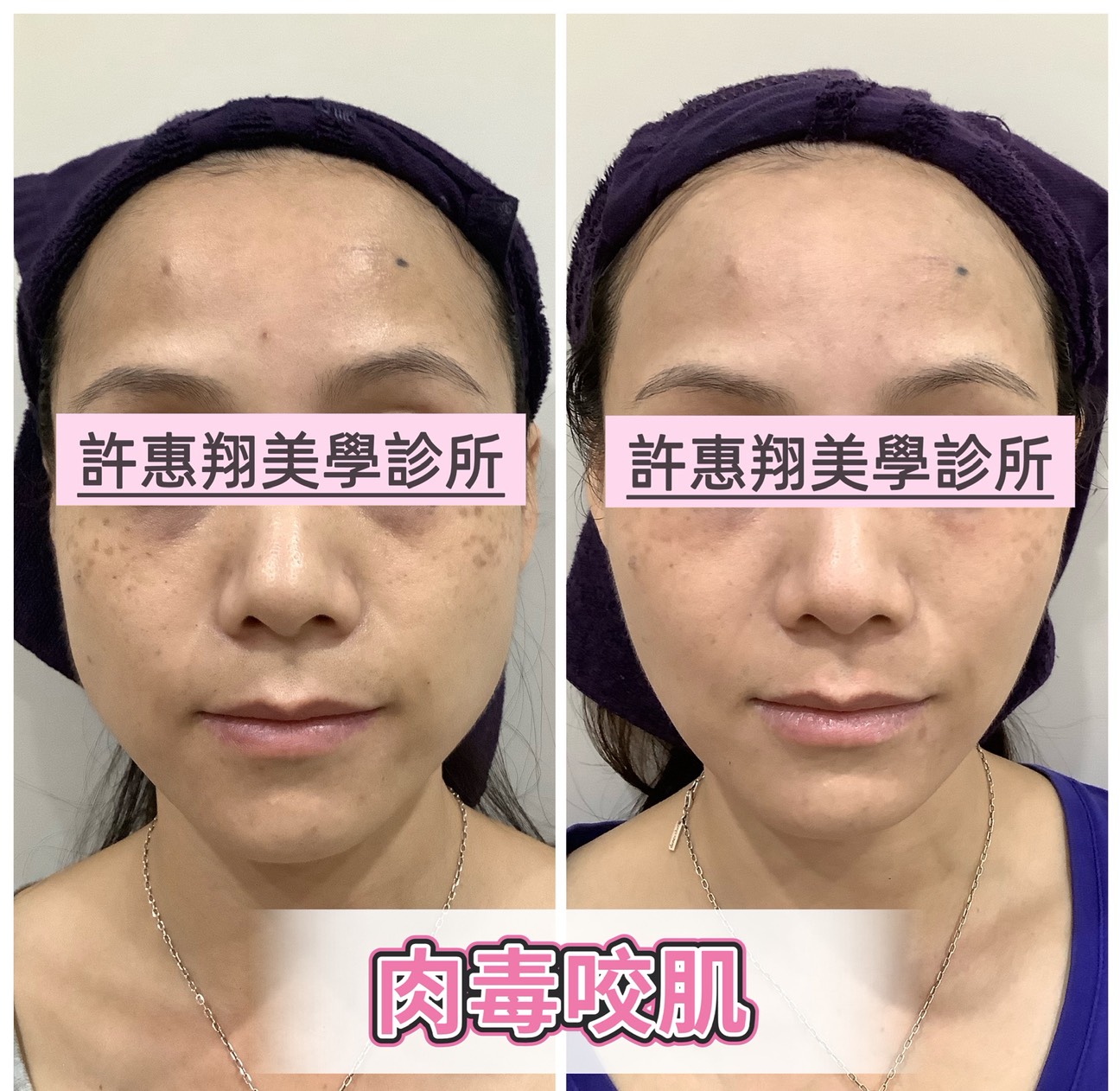 肉毒咀嚼肌真實案例 02 治療前後對照（正面）