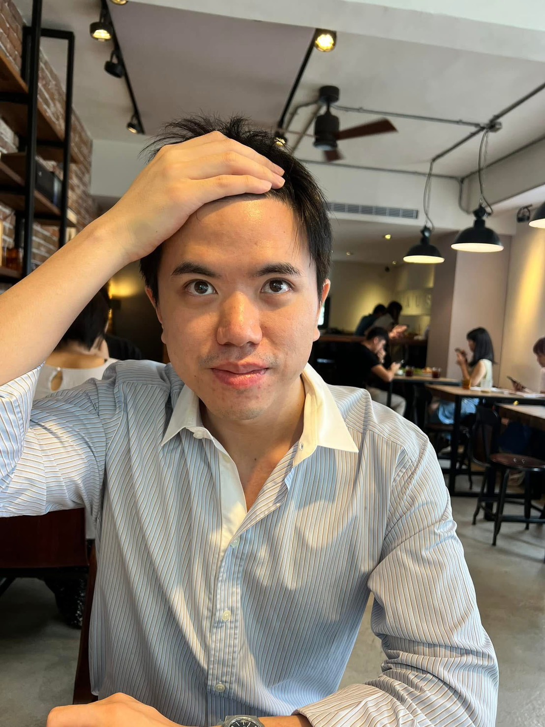 抬頭紋肉毒案例：治療後