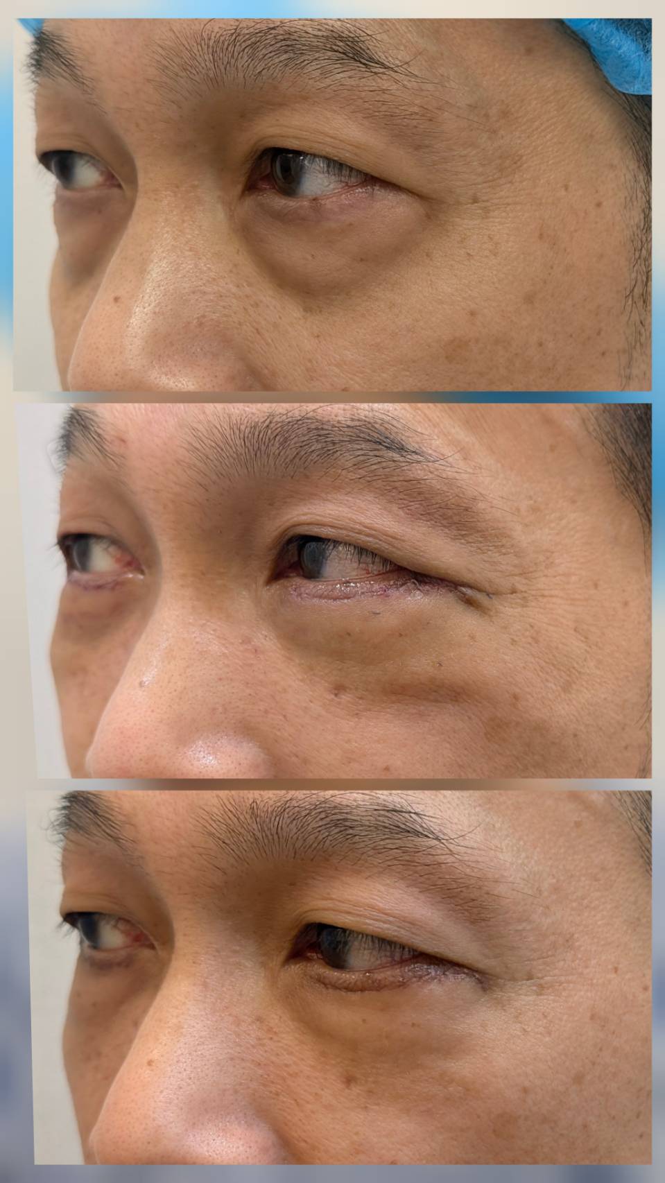 眼袋外開＋修皮手術個案 45 度側面照，上：術前；中：術後第 3 天；下：術後 1 個月｜妍回美學診所