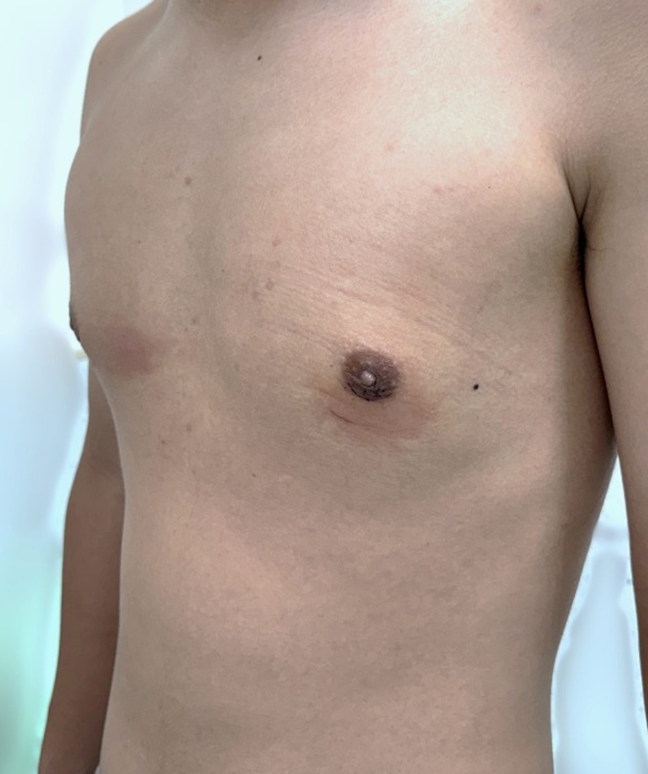男性女乳症手術 術後 7 天側面｜乳暈平整｜經本人同意刊登｜妍回美學診所