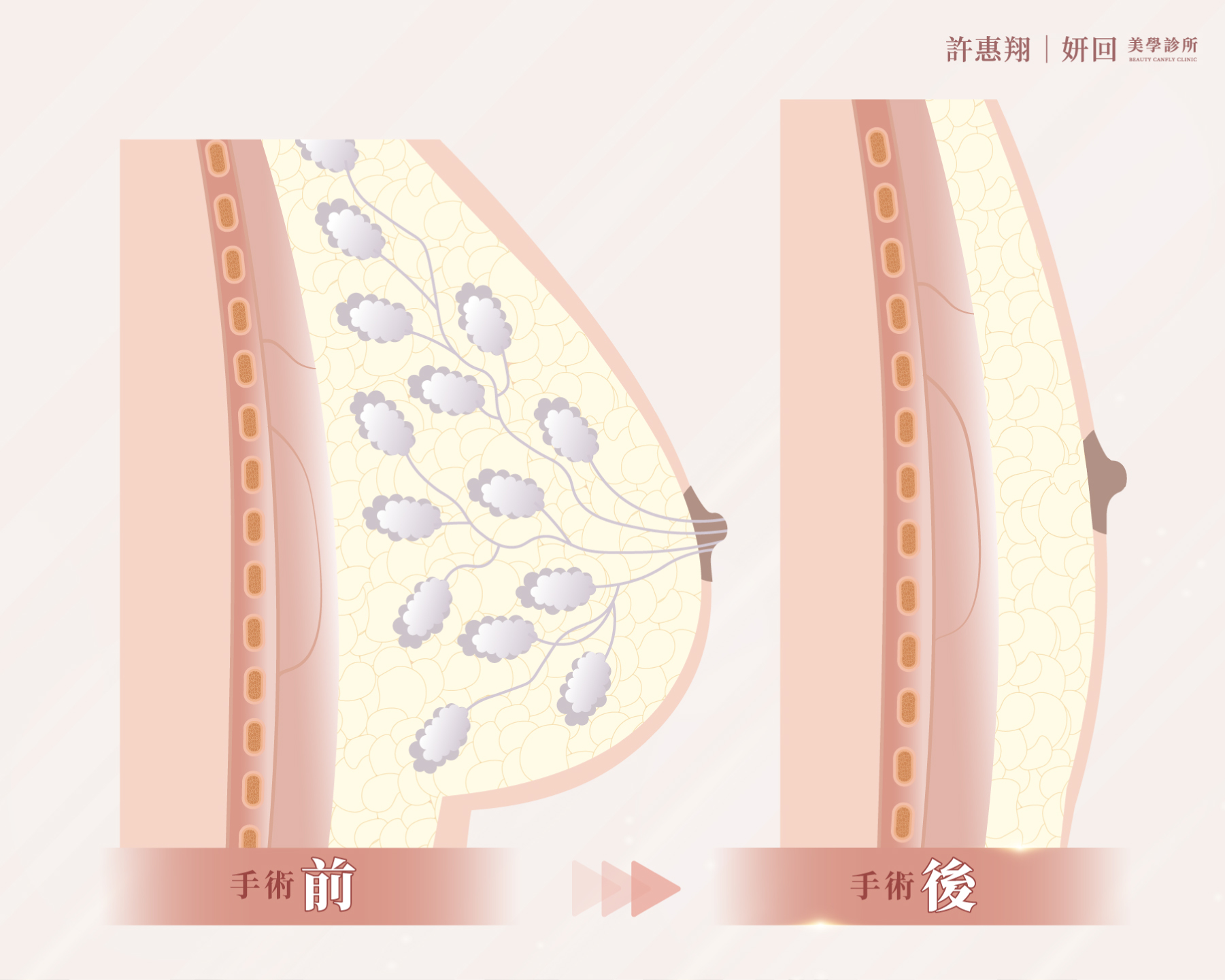 一字型平胸手術剖面示意圖：術前乳腺分布在整個胸部，術後移除乳腺與多餘皮膚、保留皮下脂肪層｜妍回美學診所