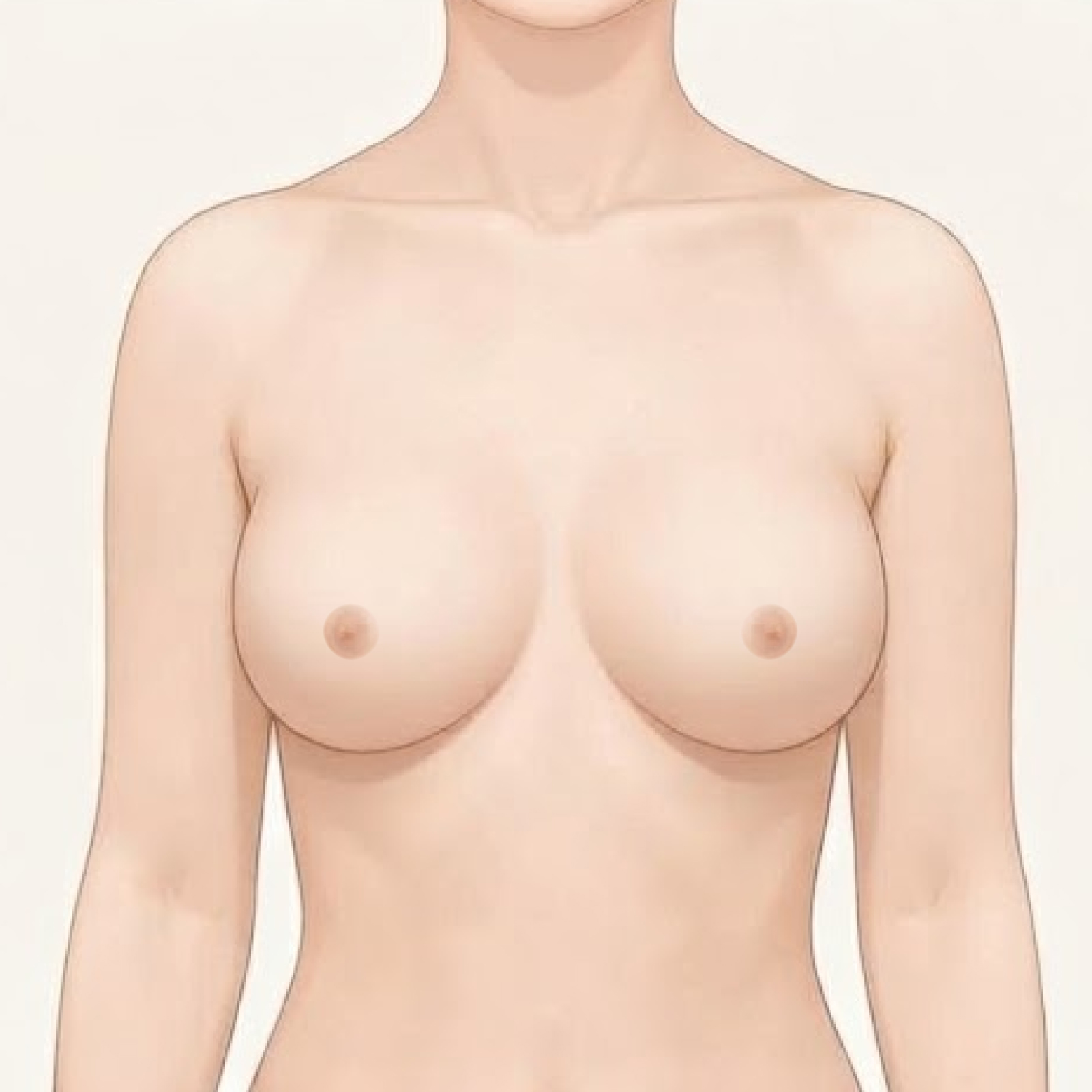提乳手術重點插畫・正面術後：乳頭上移、乳房下緣回到皺褶上方｜妍回美學診所