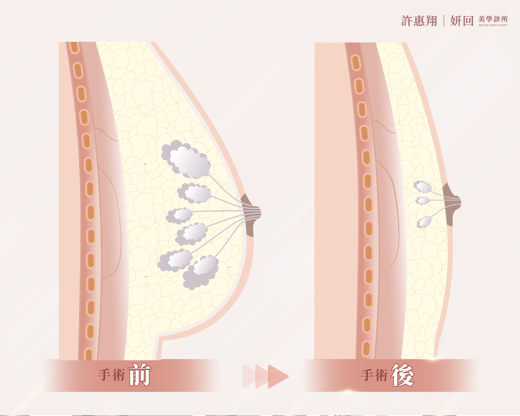 男性女乳症手術前胸部剖面示意：乳暈下方增生的乳腺｜妍回美學診所
