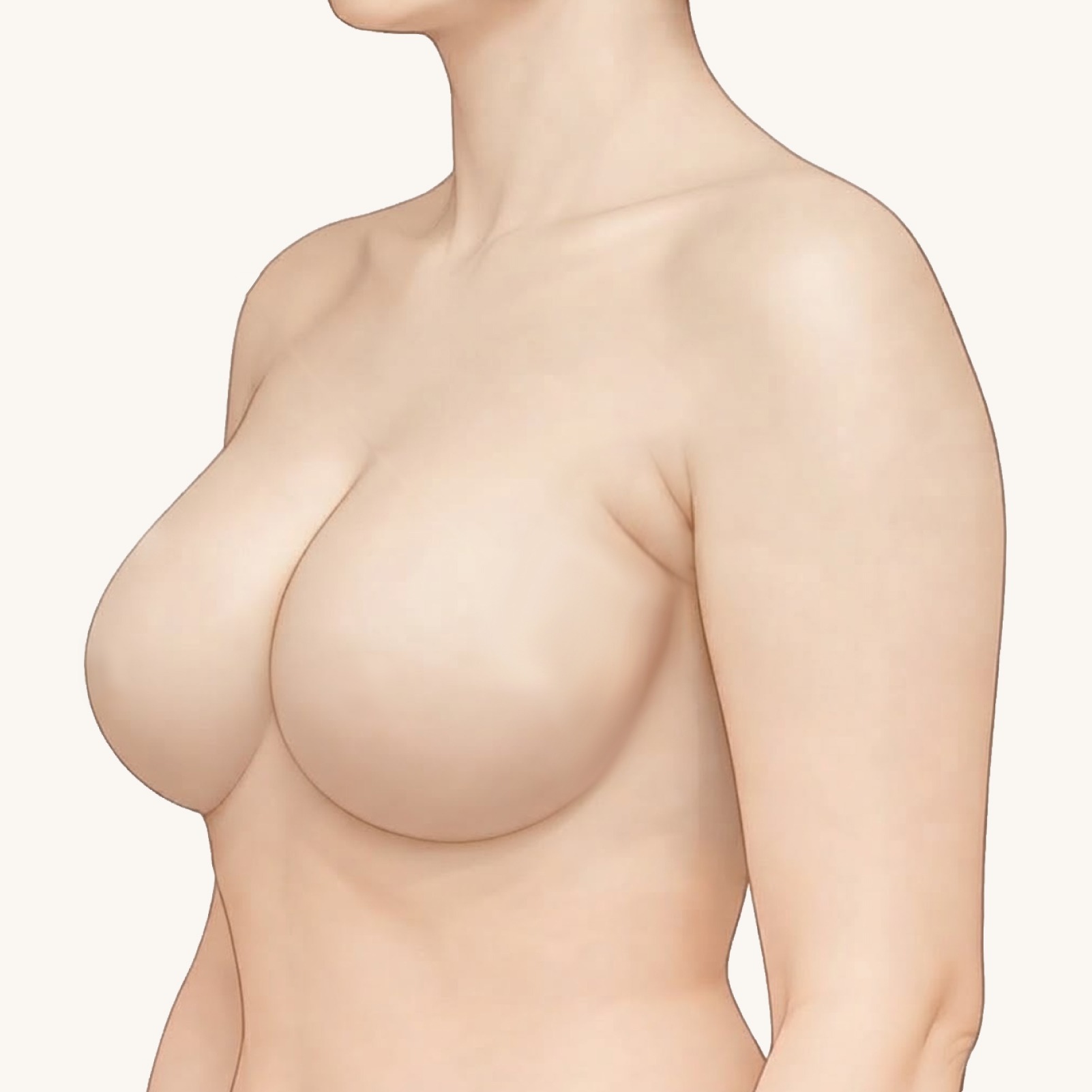 副乳手術重點插畫・斜側面術前：腋下前緣凸起，乳房外側到手臂之間組織堆積｜妍回美學診所