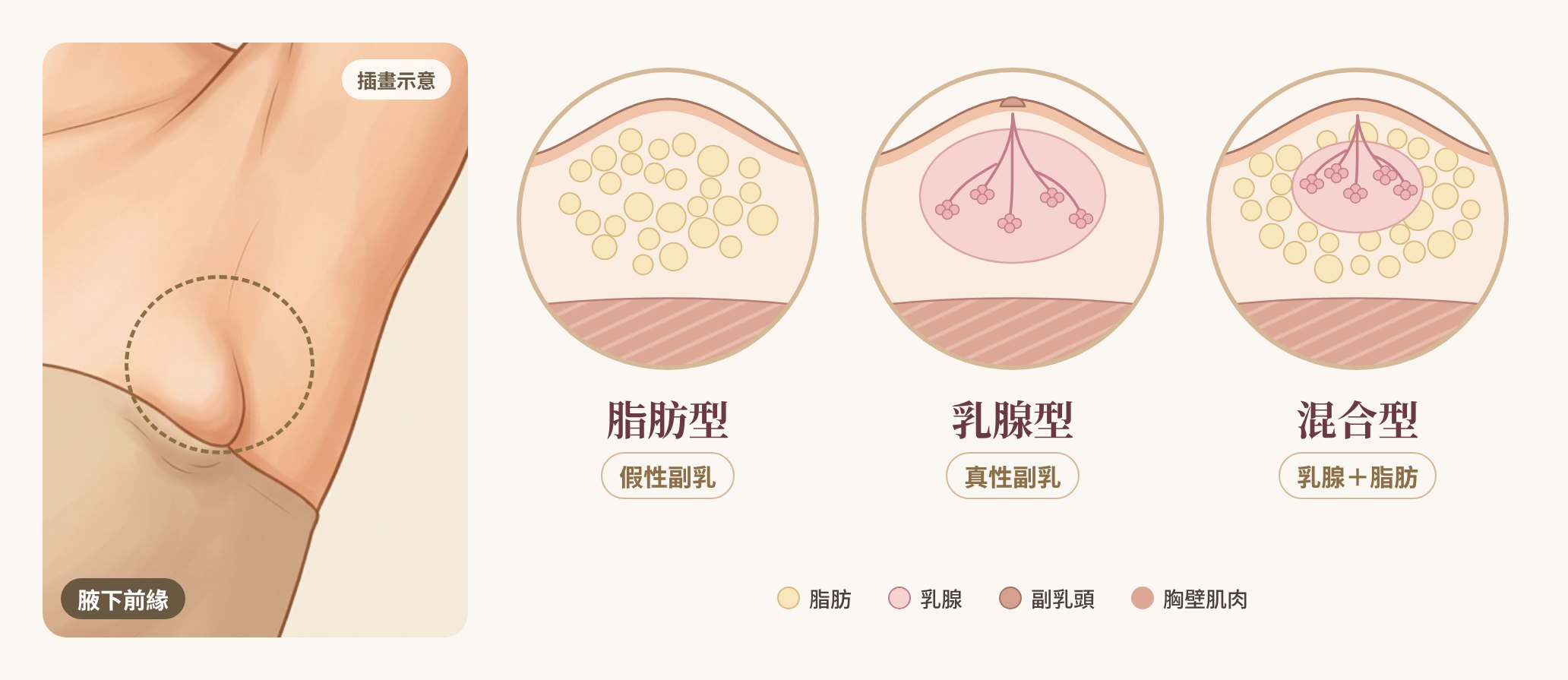 副乳分型插畫：脂肪型（假性副乳）腋下前緣是脂肪；乳腺型（真性副乳）腋下前緣是乳腺，部分有副乳頭；混合型乳腺外圍包著脂肪｜妍回美學診所