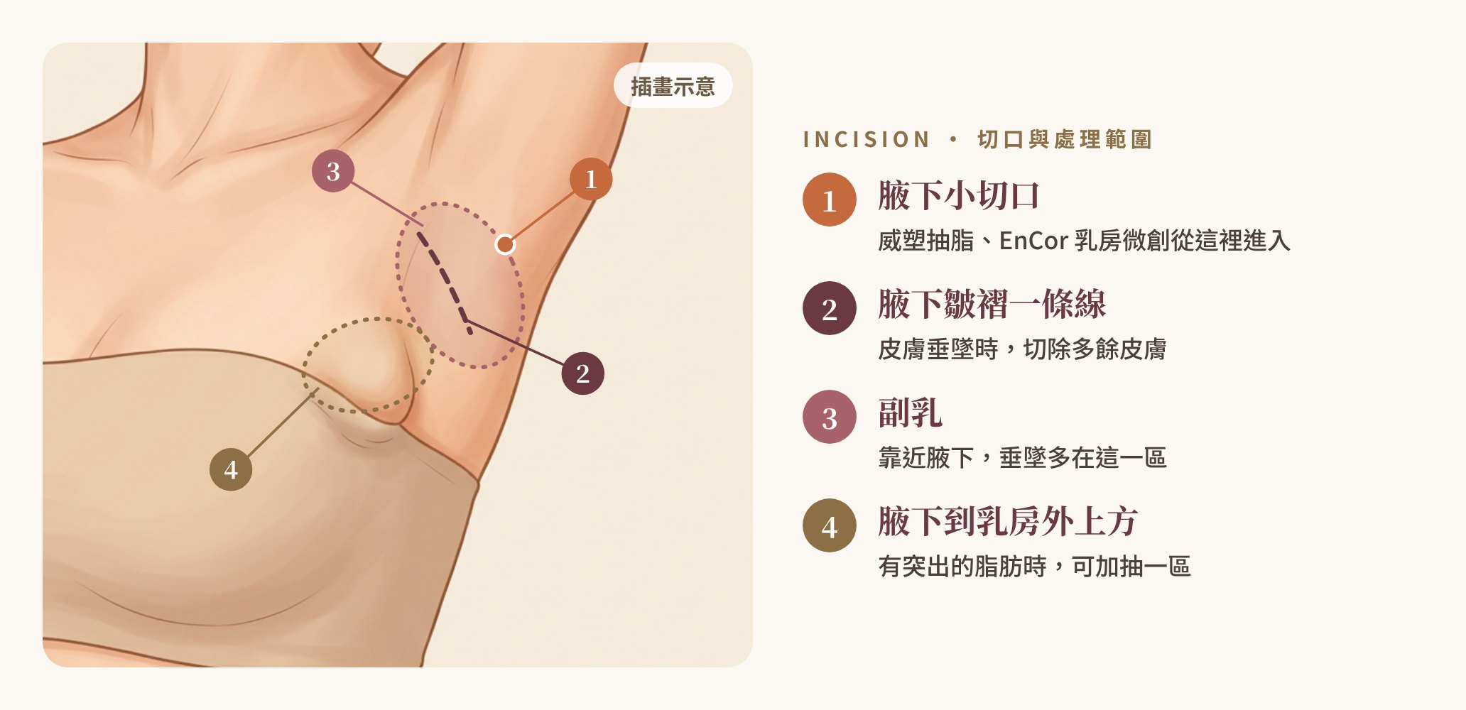 副乳手術切口與處理範圍插畫：1 腋下小切口（威塑抽脂、EnCor 乳房微創）、2 腋下皺褶一條線（皮膚垂墜時切除多餘皮膚）、3 副乳靠近腋下、4 腋下到乳房外上方突出的脂肪｜妍回美學診所