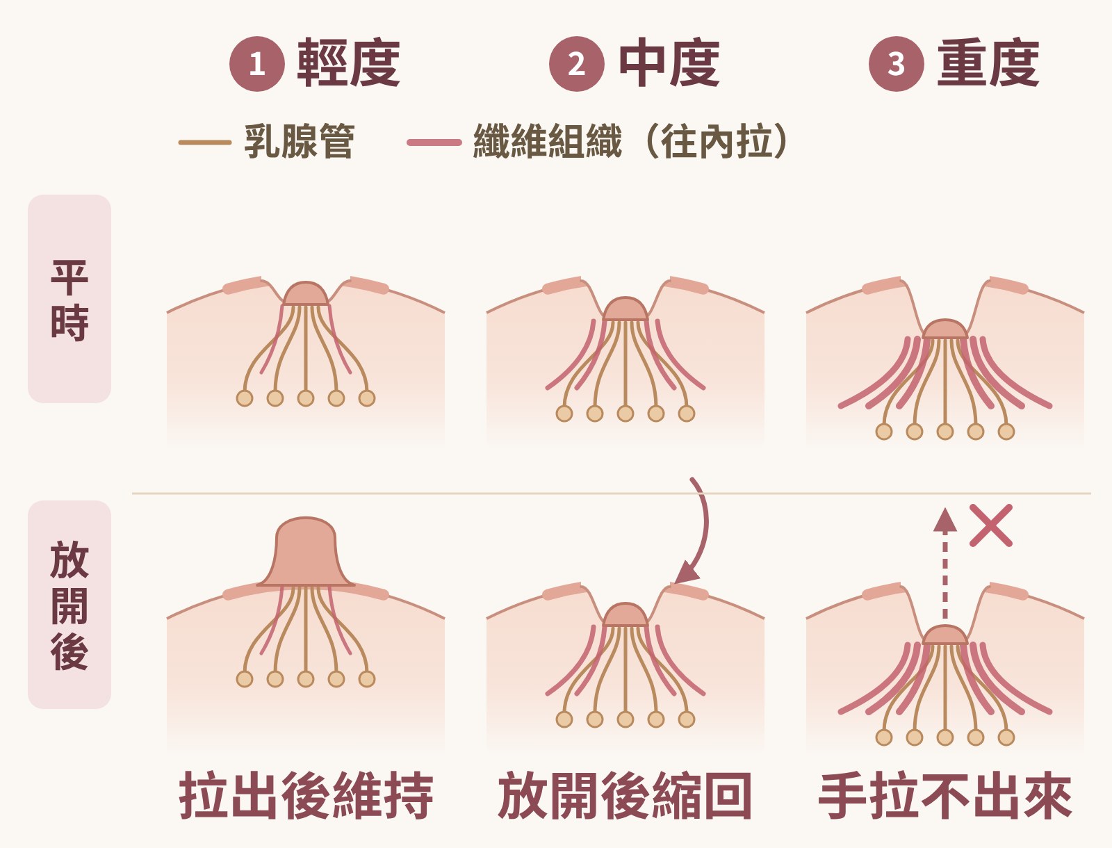 乳頭凹陷分級圖解：輕度拉出後維持突出、中度放開後縮回、重度手拉不出來；乳腺管與往內拉的纖維組織隨分級增加｜妍回美學診所