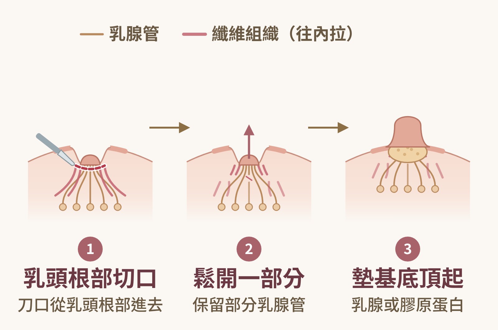 乳頭凹陷部分鬆解圖解：刀口從乳頭根部進去，輕度、中度凹陷鬆開一部分纖維組織、保留部分乳腺管，乳頭底部墊入乳腺軟墊或膠原蛋白基底把乳頭頂起來｜妍回美學診所