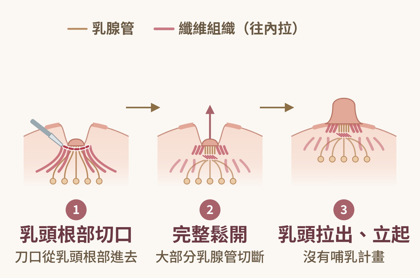 乳頭凹陷完整鬆解圖解：刀口從乳頭根部進去，重度凹陷完整鬆開纖維組織與乳腺管，乳頭拉出立起，適合未來沒有哺乳計畫｜妍回美學診所