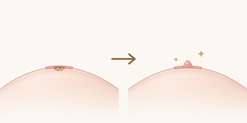凹陷處卡汙垢圖解：術前乳頭縮在凹口裡積著分泌物，術後乳頭拉出、清潔方便｜乳頭凹陷手術｜妍回美學診所