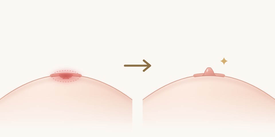 凹陷處紅腫發炎圖解：術前乳頭凹口周圍紅腫，術後乳頭拉出、凹口保持乾淨乾燥｜乳頭凹陷手術｜妍回美學診所
