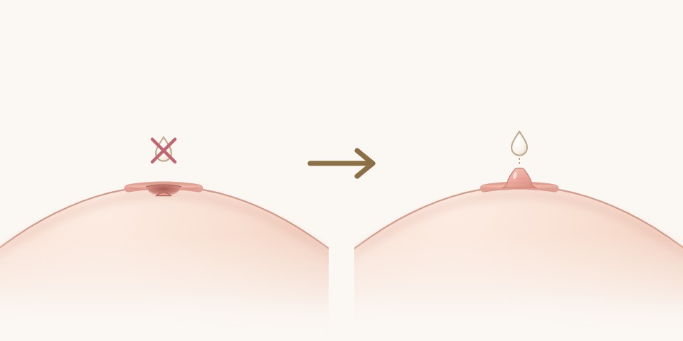 哺乳圖解：術前乳頭縮在凹口裡、乳汁出不來，術後乳頭突出、乳汁從乳頭出來｜乳頭凹陷手術｜妍回美學診所