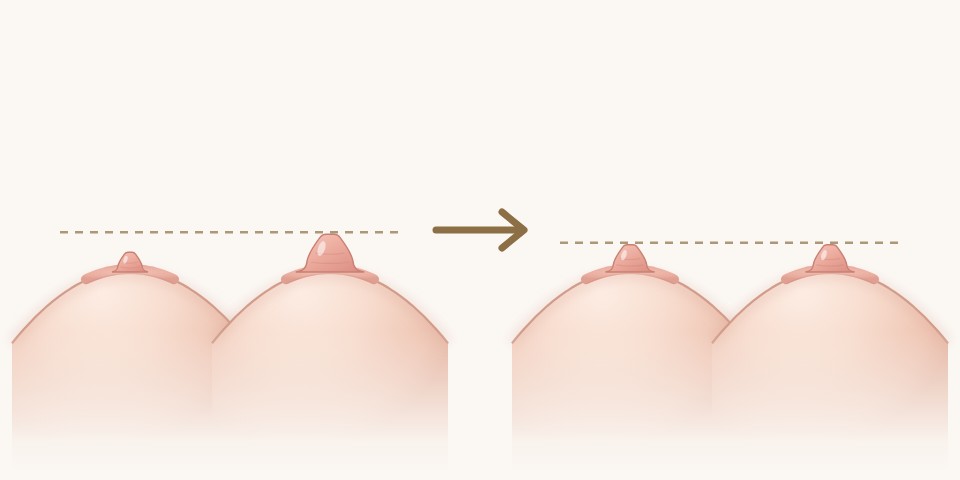 乳頭一大一小圖解：術前一側乳頭明顯較大，術後兩側乳頭大小接近｜乳頭凹陷手術｜妍回美學診所