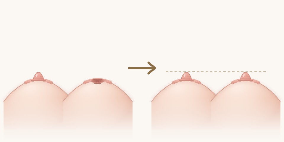 一凹一突圖解：術前一側乳頭凹陷、一側突出，術後兩側乳頭高度接近｜乳頭凹陷手術｜妍回美學診所