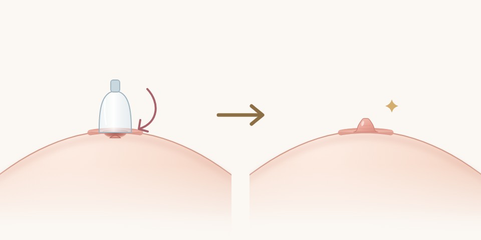 吸引器圖解：術前吸引器拉出後乳頭又縮回，術後乳頭維持在拉出的位置｜乳頭凹陷手術｜妍回美學診所
