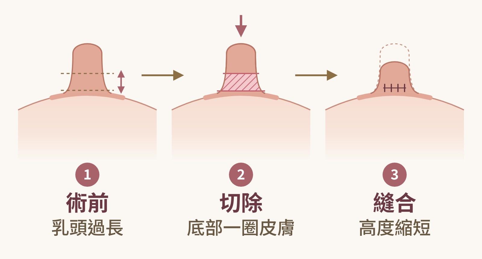 縮乳頭手術環狀切法圖解：術前乳頭過長，切除乳頭底部一圈皮膚，縫合後乳頭往下收攏、高度縮短｜妍回美學診所